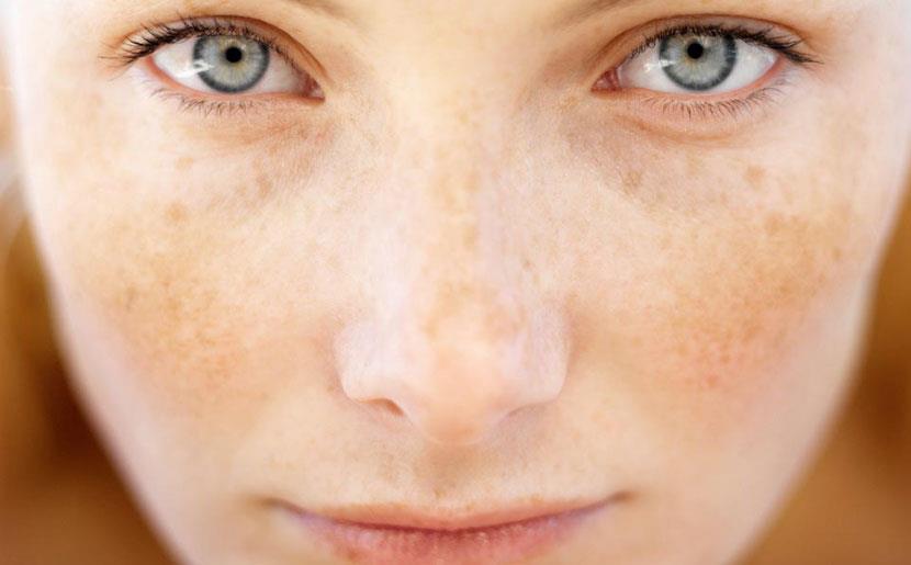 The Signs and Symptoms of Melasma 